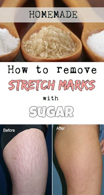 How To Remove Stretch Marks With Sugar