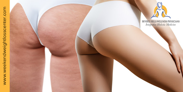 Cellulite Treatments