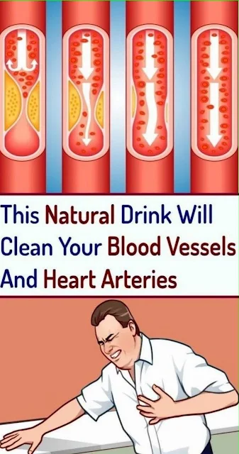 Clean Clogged Arteries: The Potion Which Pushes Fat From The Blood Vessels!