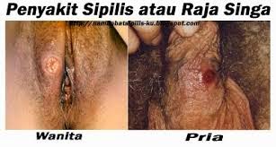 Sipilis