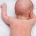 Common Types of Eczema in Children