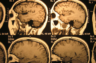 Esquizofrenia: como afeta o cérebro?