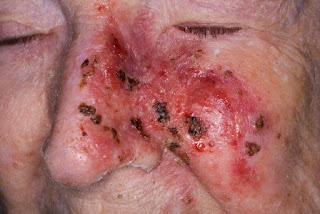 pictures of skin cancer on face