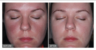 Rosacea Laser Treatment