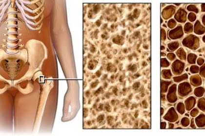  Osteoporosis: Symptoms, Causes, Types, and Home Remedies