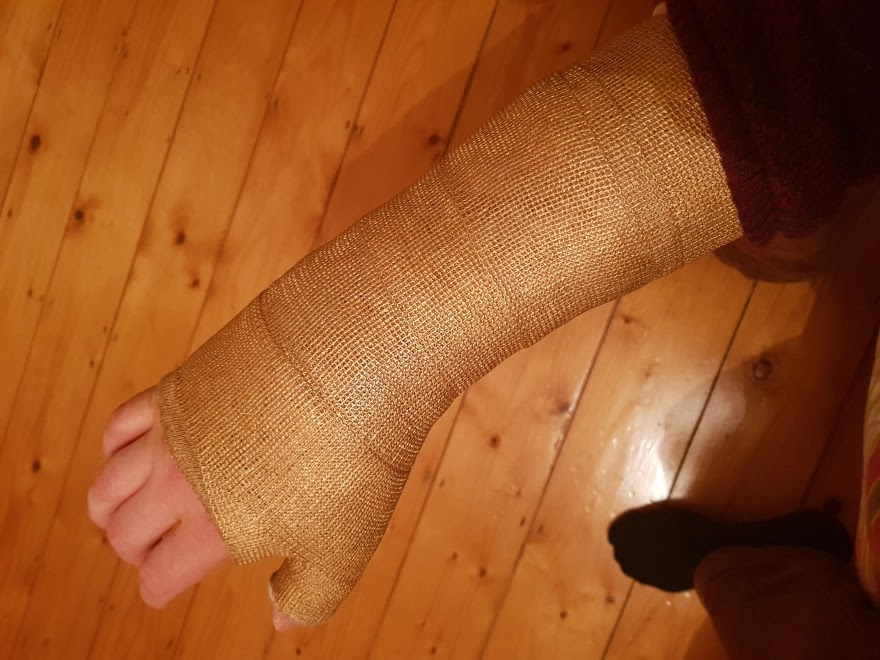 After This Guy Broke His Wrist, He Decided To Transform His Cast Into The Infinity Gauntlet Of Thanos