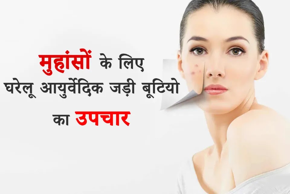 Ayurvedic Herbs for Acne in Hindi