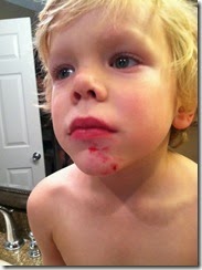 bike wreck