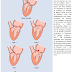 Valvulopathies mitrales