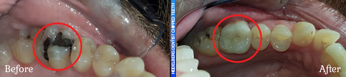 Before & After Smile Gallery For Chipped/Broken & Cracked Teeth