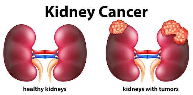 signs of kidney cancer in males