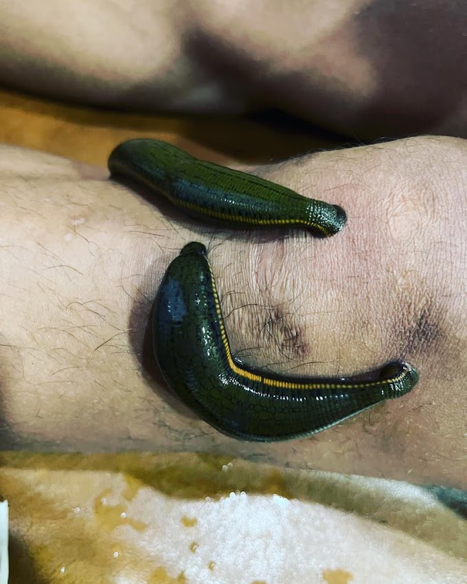  जलौका विधि (leech therapy)/A blood letting therapy