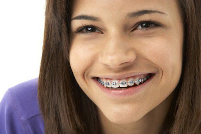 Niềng răng Invisalign giá bao nhiêu tiền ?