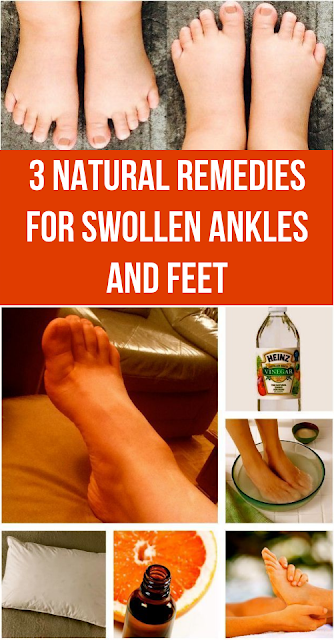 3 Natural Remedies For Swollen Ankles and Feet