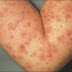 Obat Penyakit Herpes Zoster Dari Denature 