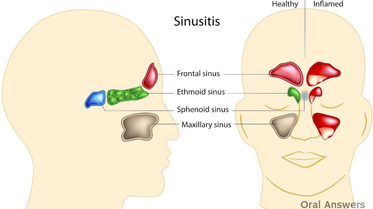 Side Effects Of Sinus Infection
