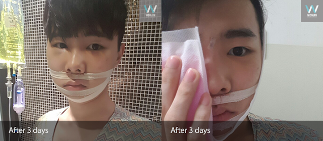 짱이뻐! - Diary Of The Best Two Jaw Surgery In Korea