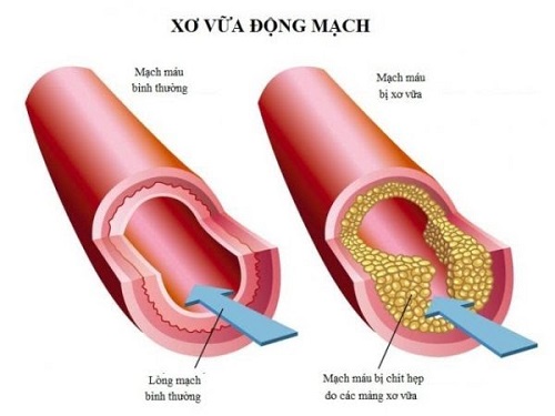 Nguyên nhân thiêu máu não ở người già