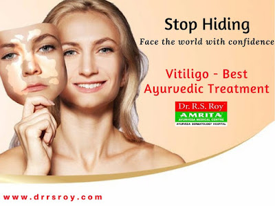 http://drrsroy.com/vitiligo.html