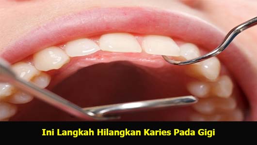 Ini Langkah Hilangkan Karies Pada Gigi