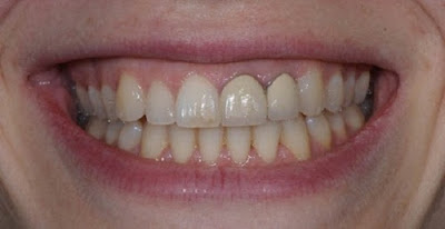 Nguyên nhân bọc răng sứ bị đen chân răng