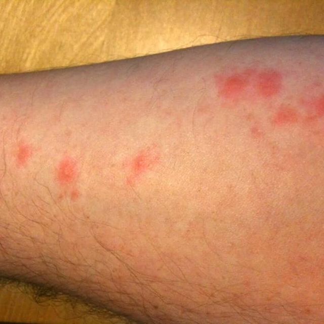 pictures of bed bug rash