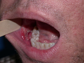 Mouth cancer pictures from chewing tobacco