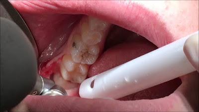 Nhổ răng khôn trong bao lâu?