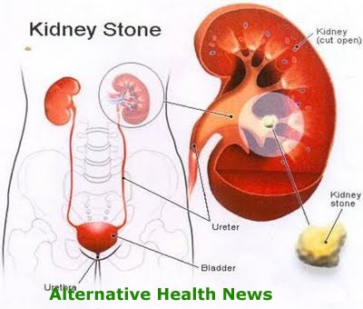 Kidney Stones