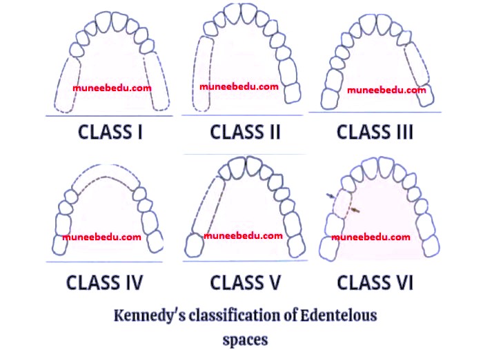 kennedy's classification system, applegates rules