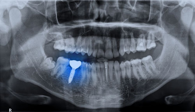 Impianti dentali vs. Protesi: quale è meglio per me?