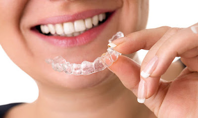 Quy trình niềng răng diễn ra như thế nào? 3