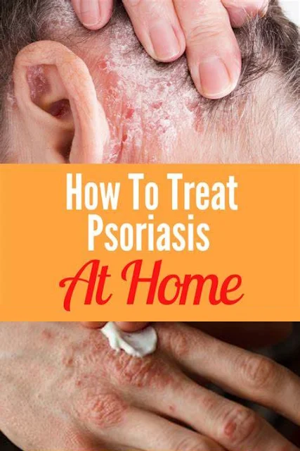 11 Ways to Treat Psoriasis at Home