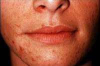 perioral dermatitis in children