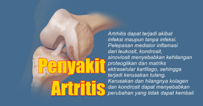 Cara Mengobati Penyakit Rheumatoid Arthritis Dengan Cepat