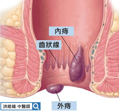 痔瘡,中醫,內痔,外痔,齒狀線,洪皓脩中醫師