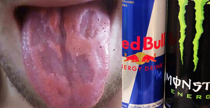 Addicted To Energy Drinks, His Tongue 'Eaten Away'  Because Of Chemicals