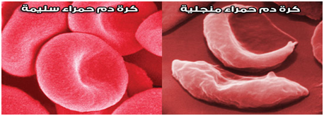 أنيميا خلايا الدم المنجلية