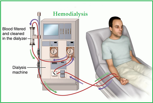 bicol hemodialysis center