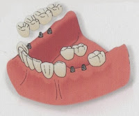 http://dentist-india-delhi.com/Dental-Implants.php