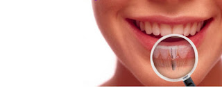 implant-dentist-sydney-bring-back-your-smile-with-dental-implants