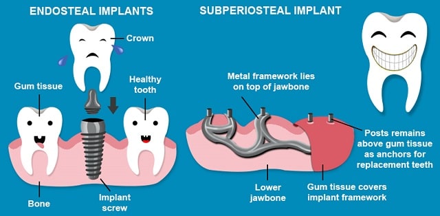 endosteal vs subperiosteal dental implants