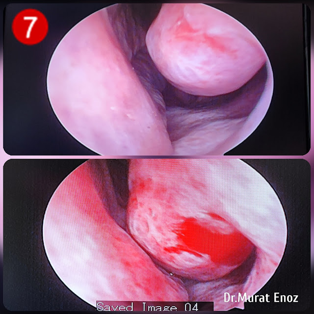 Before and after hyaluronic acid injection to augment the remnant inferior turbinate photo