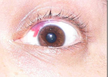 My Intra-LASIK surgery