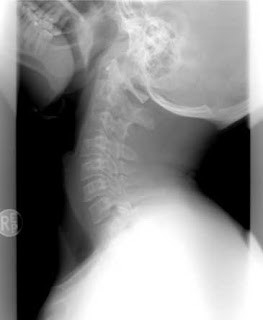 latigazo cervical