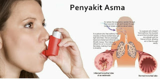 penyakit asma, obat asma, 