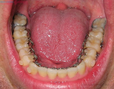 Lý do nên niềng răng mặt trong khi điều trị hô?