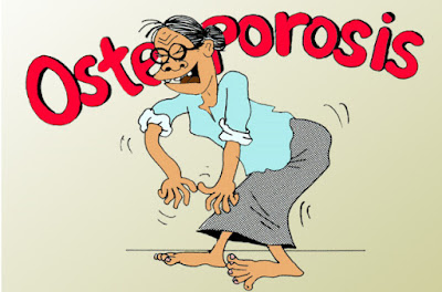 Tips Mencegah Osteoporosis Sejak Dini