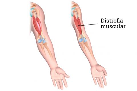Células humanas recuperam proteínas cruciais na distrofia muscular de Duchenne