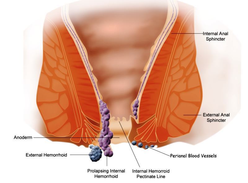 pengobatan hemoroid 